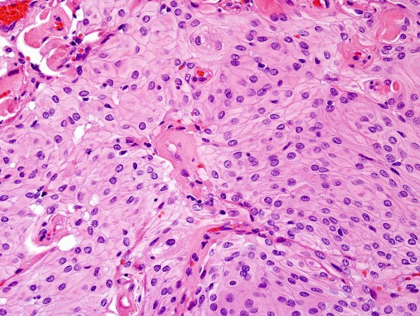 18A1 Meningioma (Case 18) H&E 1.jpg