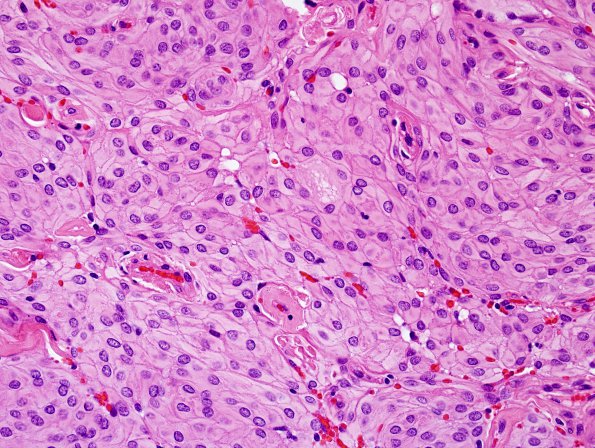 18A2 Meningioma (Case 19) H&E 3.jpg