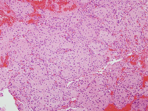 19A1 Meningioma (Case 19) cell borders H&E 4