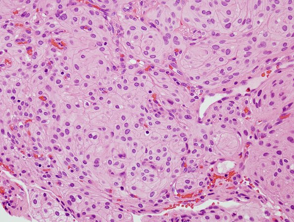 19A2 Meningioma (Case 19) cell borders H&E 2