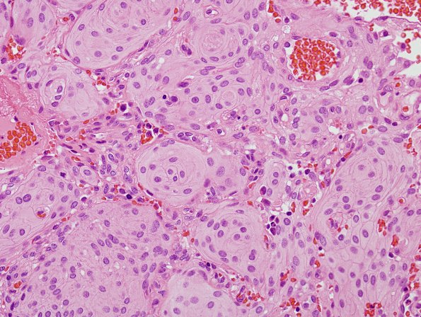 19A3 Meningioma (Case 19) cell borders H&E 1