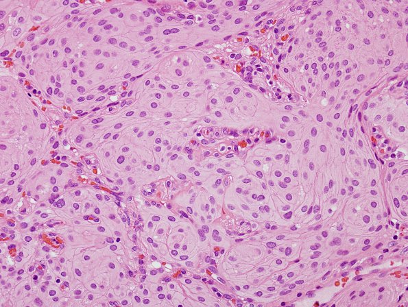 19A4 Meningioma (Case 19) cell borders H&E 3