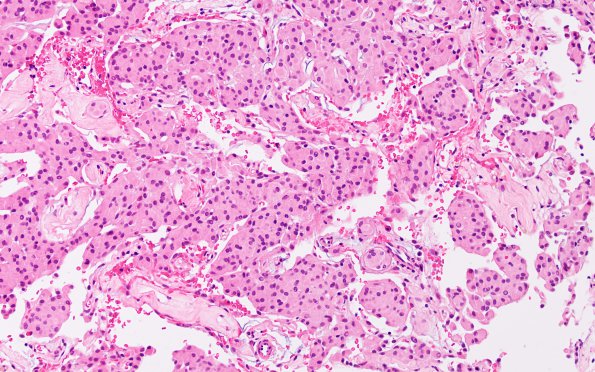 1A Meningioma (Case 1) H&E 1