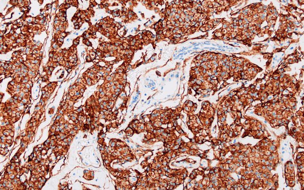 1B Meningioma (Case 1) EMA 1