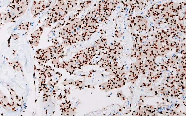 1C Meningioma (Case 1) PR