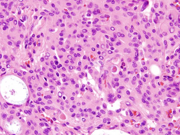 2A Meningioma (Case 2)