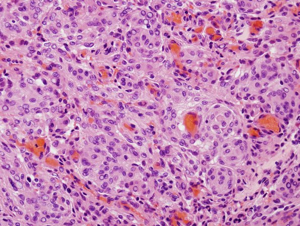 3A Meningioma (Case 3) H&E