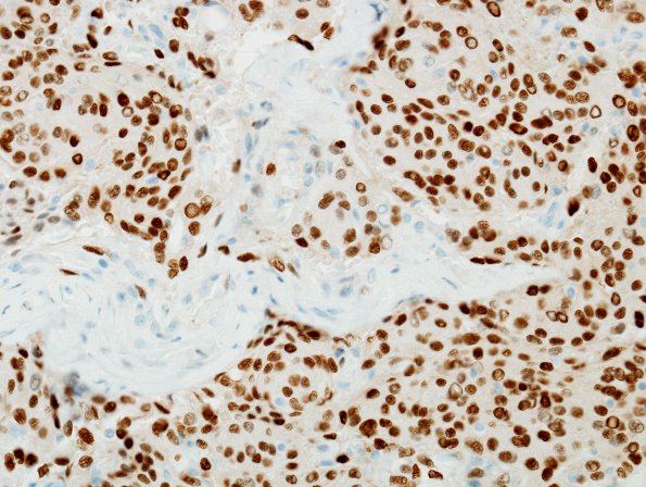 3B Meningioma (Case 3) PR 1