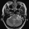 4A Meningioma (Case 4) T2 2 - Copy