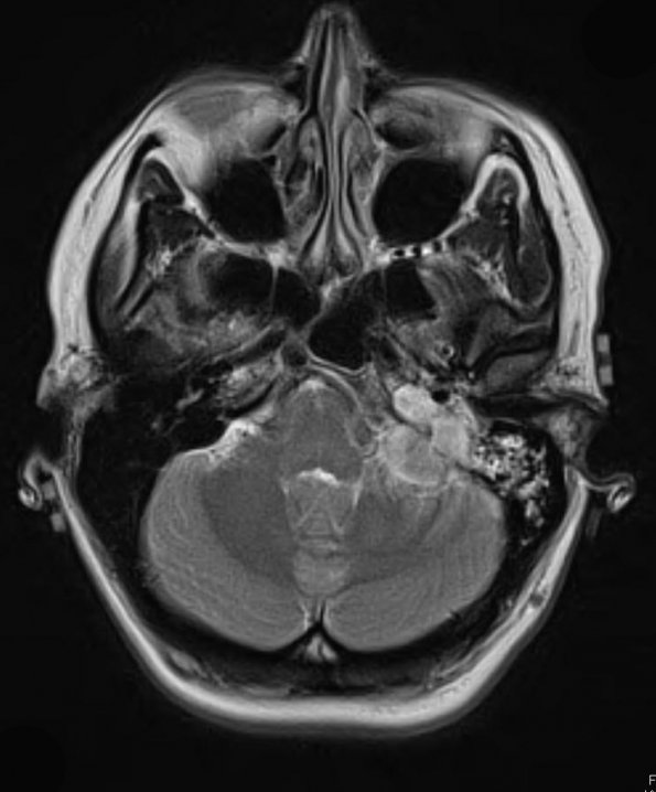 4A Meningioma (Case 4) T2 2 - Copy