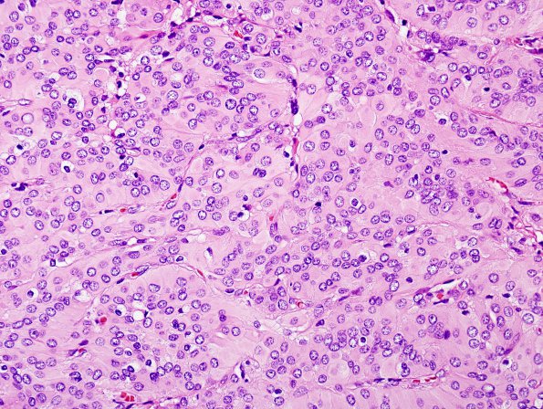 4B1 Meningioma (Case 4) H&E 1