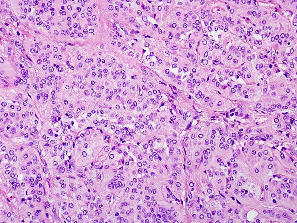 4B2 Meningioma (Case 4) H&E 2