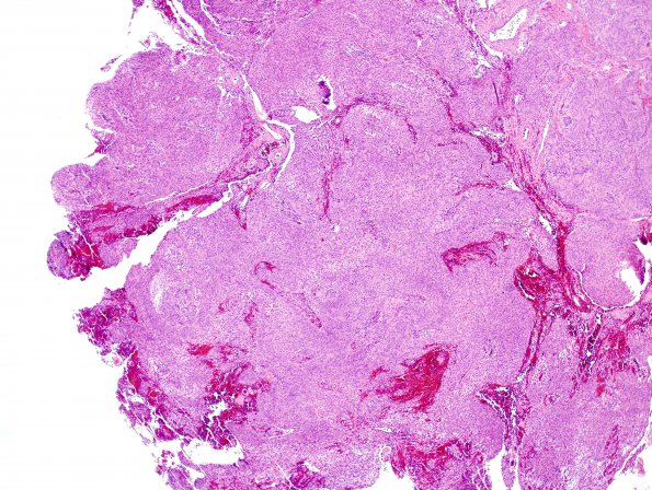 5A Meningioma (Case 5) H&E 1