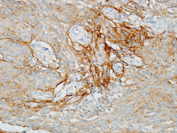 5B2 Meningioma (Case 5) EMA 3