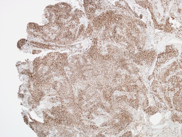 5C1 Meningioma (Case 5) PR 1