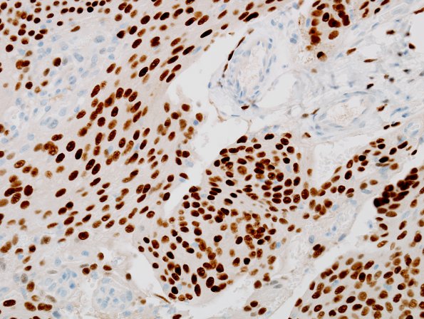 5C2 Meningioma (Case 5) PR 2