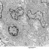 6A1 Meningioma (Case 6) EM 6 - Copy