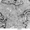 6A2 Meningioma (Case 6) EM 11 - Copy