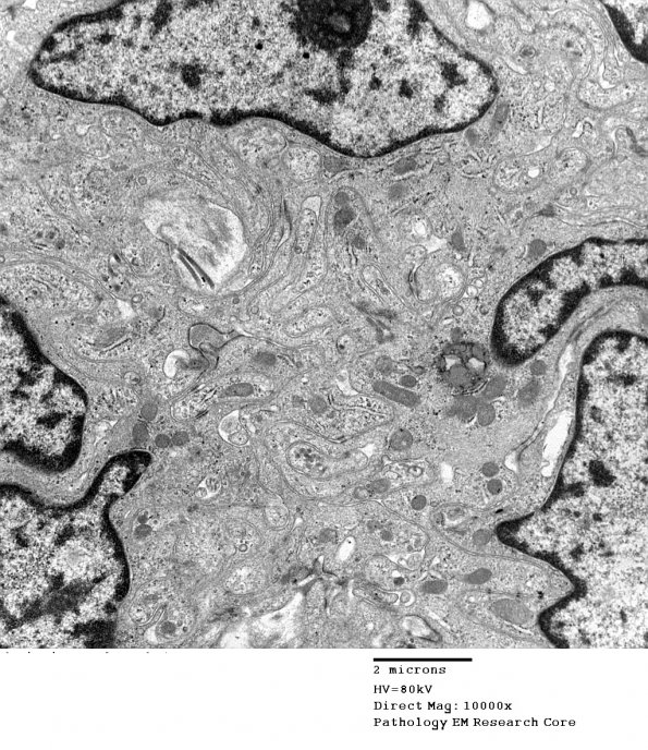 6A2 Meningioma (Case 6) EM 11 - Copy