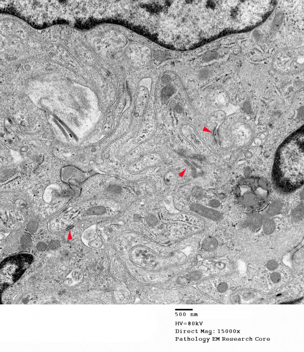 6A3 Meningioma (Case 6) EM 12 copy - Copy