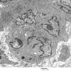 6A4 Meningioma (Case 6) EM 18 - Copy