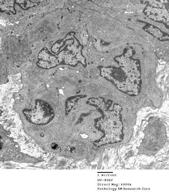 6A4 Meningioma (Case 6) EM 18 - Copy