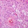 7A Meningioma (Case 7) foamy cells H&E 1