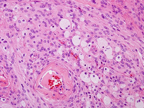 7A Meningioma (Case 7) foamy cells H&E 1