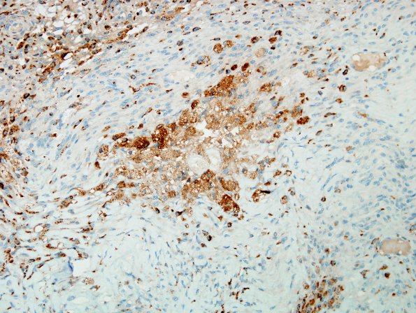 7B Meningioma (Case 7) foamy cells CD68