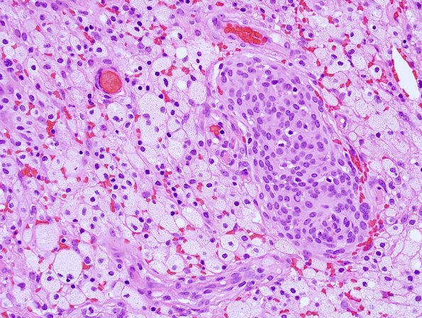 7C Meningioma (Case 7C) xanthomatous change H&E 1