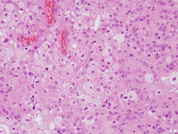 7D Meningioma (Case 7D) H&E 4