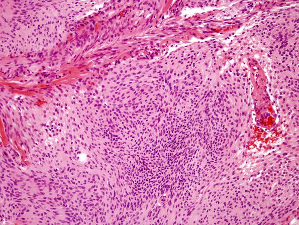 8A Meningioma (Case 8) small cells 1