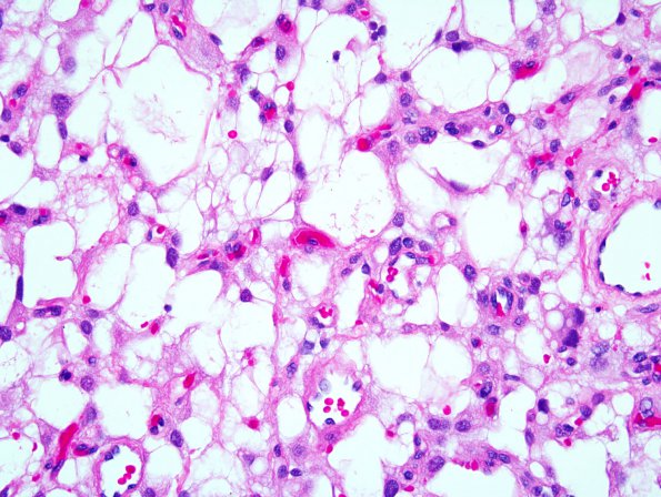 1A1 Meningioma, microcystic (Case 1) 3.jpg