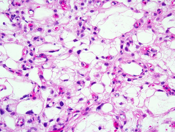 1A2 Meningioma, microcystic (Case 1) 1.jpg