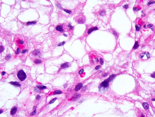 1A3 Meningioma, microcystic (Case 1) 2.jpg