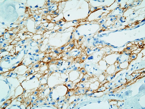 1B2 Meningioma, microcystic (Case 1) EMA 3.jpg