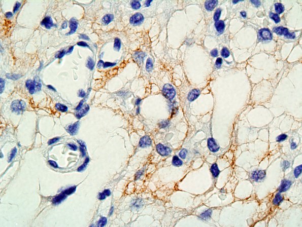 1B3 Meningioma, microcystic (Case 1) EMA 1.jpg