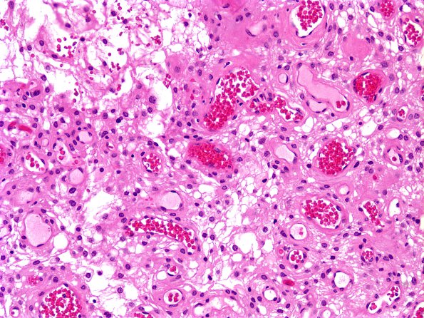 2A1 Meningioma, microcystic (Case 2) 1