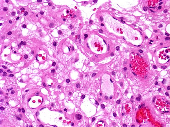 2A2 Meningioma, microcystic (Case 2)  a