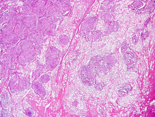 3A2 Meningioma, microcystic (Case 3) H&E 6