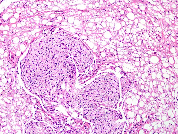 3A4 Meningioma, microcystic (Case 3) H&E 4