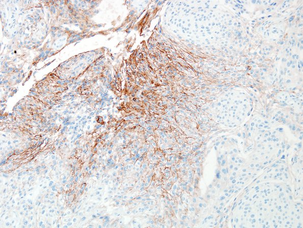 3B1 Meningioma, microcystic (Case 3) EMA 4