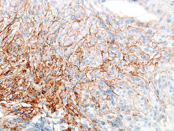 3B2 Meningioma, microcystic (Case 3) EMA 5