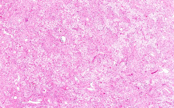 4B1 Meningioma, Microcystic Angiomatous (Case 4) MRI 3 (2)