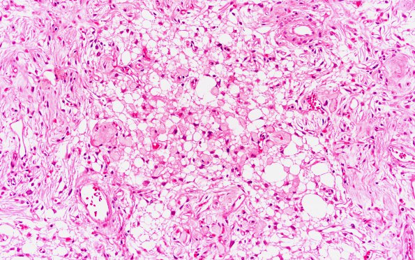 4B2 Meningioma, Microcystic Angiomatous (Case 4) 20X