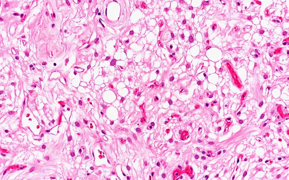 4B3 Meningioma, Microcystic Angiomatous (Case 4) 20X