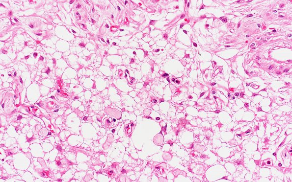 4B4 Meningioma, Microcystic Angiomatous (Case 4) 40X