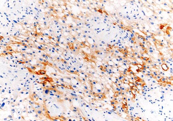 4C1 Meningioma, Microcystic Angiomatous (Case 4) EMA 20X