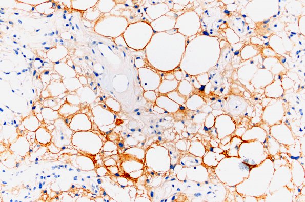 4C2 Meningioma, Microcystic Angiomatous (Case 4) 20X