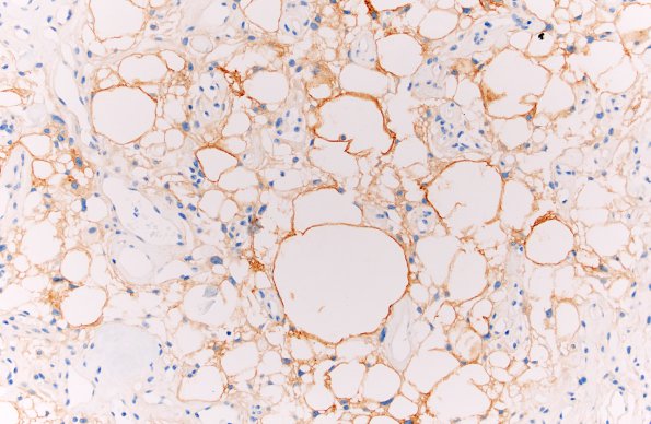 4C3 Meningioma, Microcystic Angiomatous (Case 4) EMA 20X